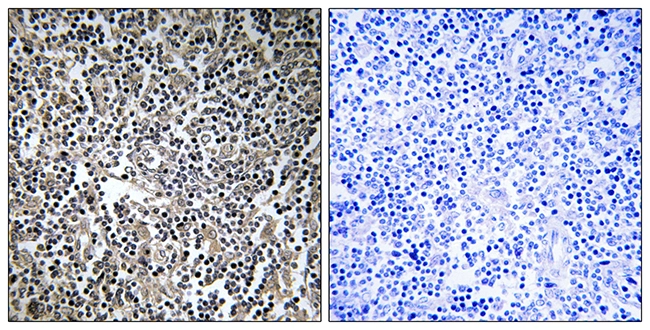IHC-P analysis of human lymph node tissue using GTX87982 MPRIP antibody. The picture on the right is blocked with the synthesized peptide. IHC-P analysis of human lymph node tissue using GTX87982 MPRIP antibody. The picture on the right is blocked with the synthesized peptide.