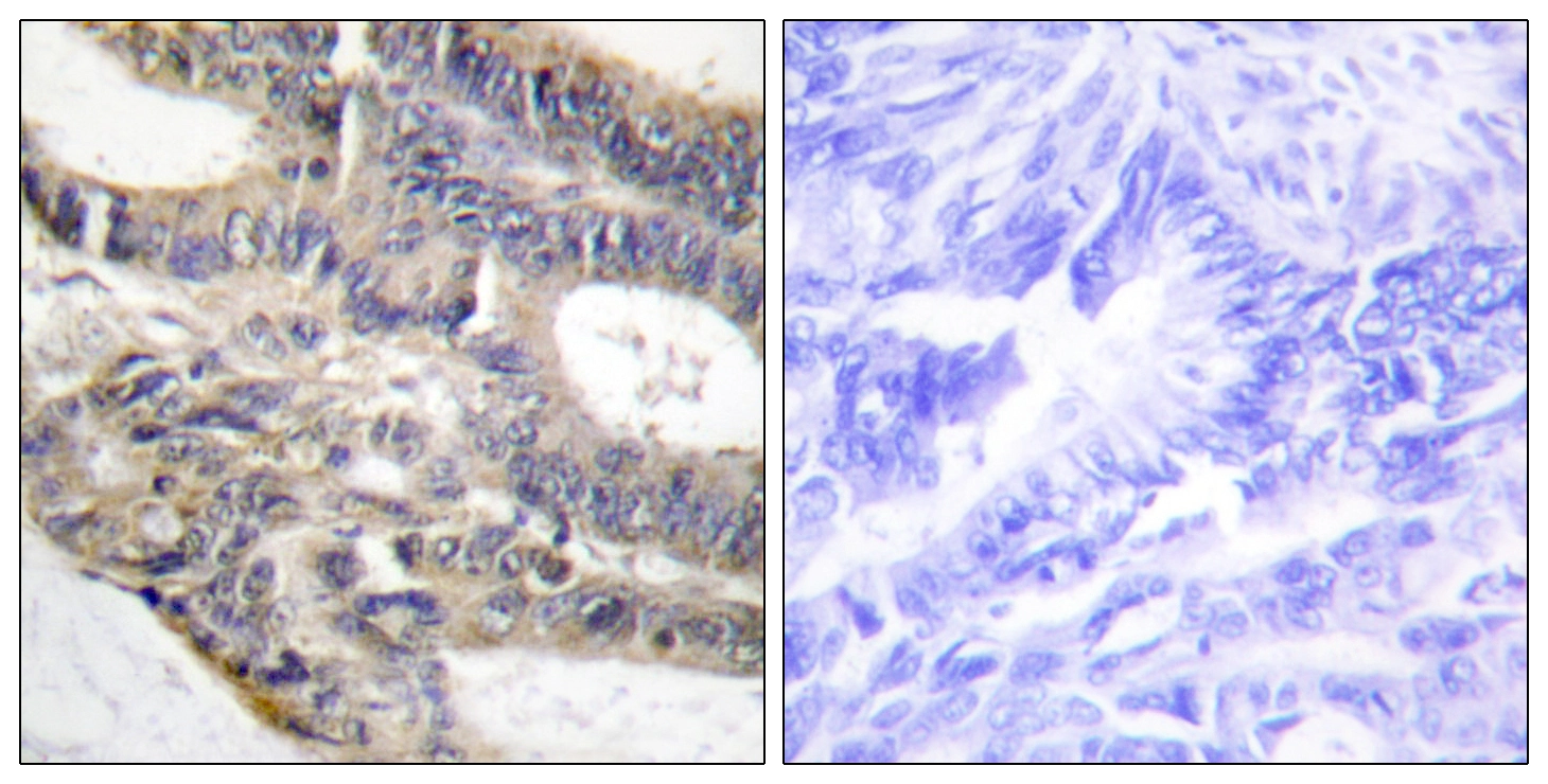 IHC-P analysis of human colon carcinoma tissue using GTX87983 AS250 antibody. The picture on the right is blocked with the synthesized peptide.