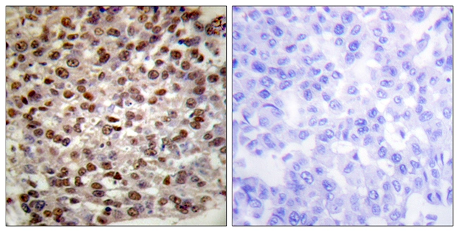 IHC-P analysis of human breast carcinoma tissue using GTX88002 Histone H2BK15ac (acetyl Lys15) antibody. The picture on the right is blocked with the synthesized peptide.