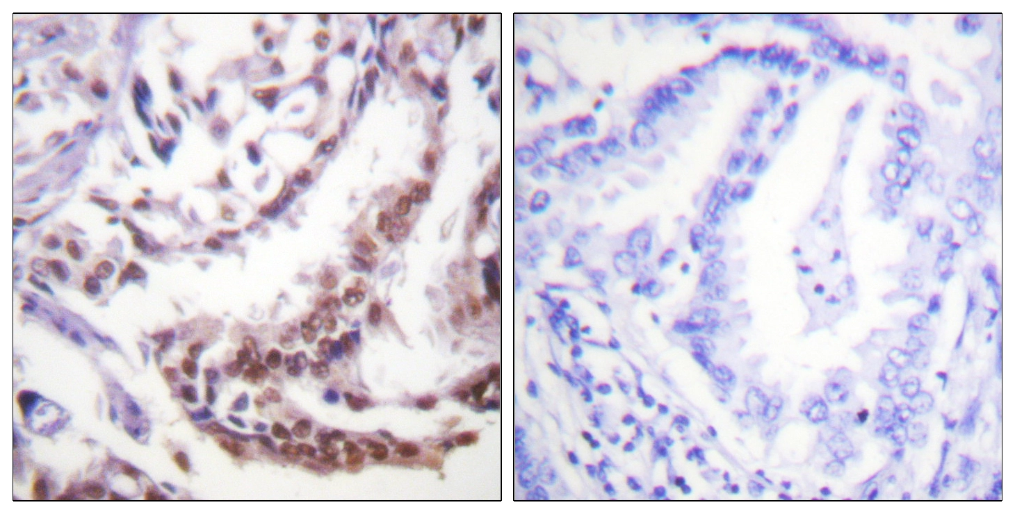 IHC-P analysis of human lung carcinoma tissue using GTX88007 Histone H3K9ac (Acetyl Lys9) antibody. The picture on the right is blocked with the synthesized peptide.