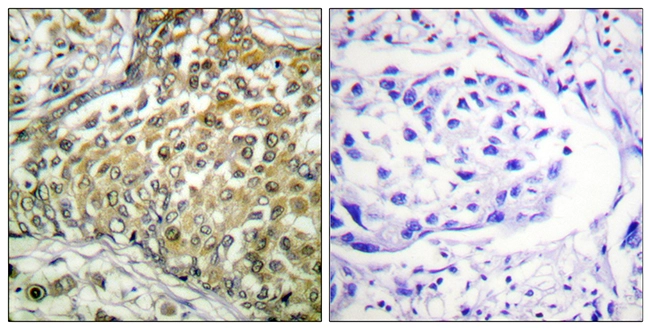 IHC-P analysis of human lung carcinoma tissue using GTX88013 p53 (acetyl Lys379) antibody. The picture on the right is blocked with the synthesized peptide.
