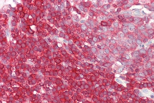 IHC-P analysis of paraffin embedded human colon using GTX88185 LSP1 antibody, C-term. Antigen retrieval : Steamed antigen retrieval with citrate buffer pH 6 Dilution : 3.75microg/ml IHC-P analysis of paraffin embedded human colon using GTX88185 LSP1 antibody, C-term. Antigen retrieval : Steamed antigen retrieval with citrate buffer pH 6 Dilution : 3.75microg/ml