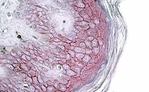 IHC-P analysis of human skin using GTX88319 Desmoglein 1 antibody, Internal. Antigen retrieval : citrate buffer pH 6 Dilution : 3.8microg/ml IHC-P analysis of human skin using GTX88319 Desmoglein 1 antibody, Internal. Antigen retrieval : citrate buffer pH 6 Dilution : 3.8microg/ml