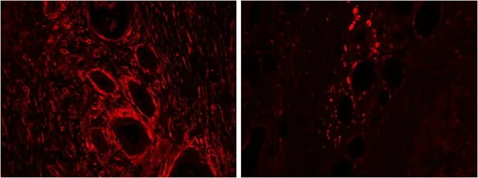 IHC-P analysis of human pancreas: cancer (left), adjacent to cancer (right) using GTX88386 Heme Oxygenase 2 antibody, Internal. Antigen retrieval : citrate buffer pH 6 Dilution : 2microg/ml