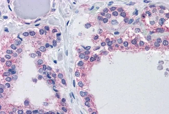 IHC-P analysis of human thyroid using GTX88422 CENTG1 antibody, Internal. Antigen retrieval : citrate buffer pH 6 Dilution : 3.75microg/ml