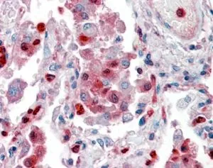 IHC-P analysis of human lung using GTX88481 S100A9 antibody, Internal. Antigen retrieval : citrate buffer pH 6 Dilution : 2.5microg/ml