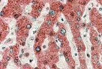 IHC-P analysis of human liver using GTX88686 HRASLS2 antibody, Internal. Antigen retrieval : Tris/EDTA buffer pH 9 Dilution : 5microg/ml IHC-P analysis of human liver using GTX88686 HRASLS2 antibody, Internal. Antigen retrieval : Tris/EDTA buffer pH 9 Dilution : 5microg/ml