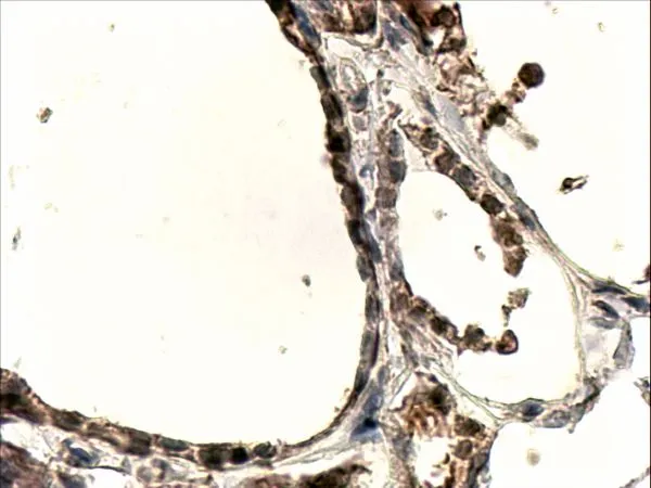 IHC-P analysis of human thyroid Gland using GTX88773 DUOX1 antibody, Internal. Antigen retrieval : Tris/EDTA buffer pH 9 Dilution : 4microg/ml IHC-P analysis of human thyroid Gland using GTX88773 DUOX1 antibody, Internal. Antigen retrieval : Tris/EDTA buffer pH 9 Dilution : 4microg/ml