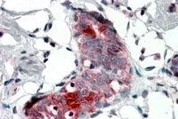 IHC-P analysis of human breast using GTX88957 Mammaglobin A antibody, Internal. Antigen retrieval : citrate buffer pH 6 Dilution : 4microg/ml IHC-P analysis of human breast using GTX88957 Mammaglobin A antibody, Internal. Antigen retrieval : citrate buffer pH 6 Dilution : 4microg/ml
