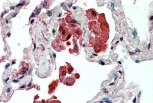 IHC-P analysis of human lung using GTX89007 IDE antibody, Internal. Antigen retrieval : citrate buffer pH 6 Dilution : 2.5microg/ml
