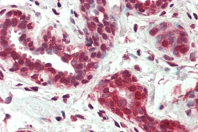 IHC-P analysis of human breast using GTX89206 NUR77 (isoform a) antibody, Internal. Antigen retrieval : citrate buffer pH 6 Dilution : 5microg/ml