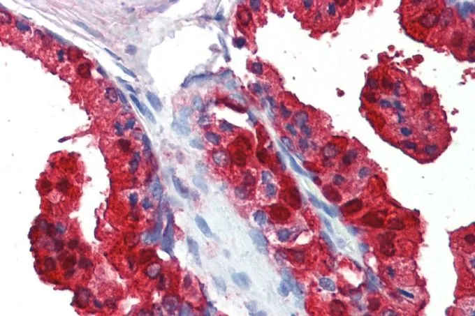IHC-P analysis of human prostate using GTX89635 Sorbitol Dehydrogenase antibody, C-term. Antigen retrieval : citrate buffer pH 6 Dilution : 5microg/ml