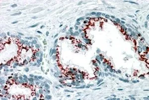 IHC-P analysis of human prostate using GTX89715 GOLPH2 antibody, C-term. Antigen retrieval : citrate buffer pH 6 Dilution : 3.75microg/ml IHC-P analysis of human prostate using GTX89715 GOLPH2 antibody, C-term. Antigen retrieval : citrate buffer pH 6 Dilution : 3.75microg/ml