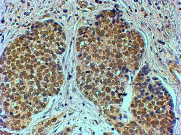 IHC-P analysis of human breast cancer using GTX89729 TIF1 alpha antibody,C-term. Antigen retrieval : citrate buffer pH 6 Dilution : 4ug/ml