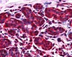 IHC-P analysis of human breast using GTX89849 ALS2CR1 antibody, C-term. Antigen retrieval : citrate buffer pH 6 Dilution : 2.5microg/ml