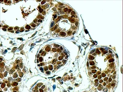 IHC-P analysis of human breast using GTX89912 APE1 antibody, N-term. Antigen retrieval : Tris/EDTA buffer pH 9 Dilution : 4microg/ml