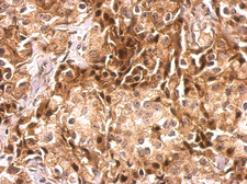 Anti-CDR2 antibody used in IHC (Paraffin sections) (IHC-P). GTX129122