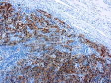Anti-Melanoma antibody [HMB45] (ready-to-use) used in IHC (Paraffin sections) (IHC-P). GTX20906